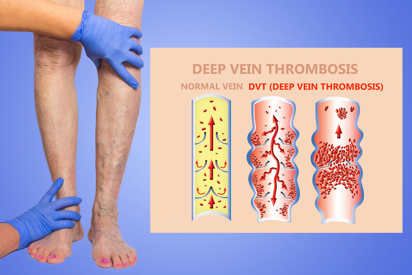 Secondary Elasticity Venous Thrombosis Varicose Compression